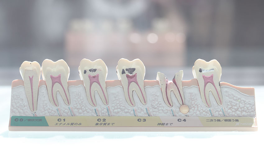 虫歯の進行模型