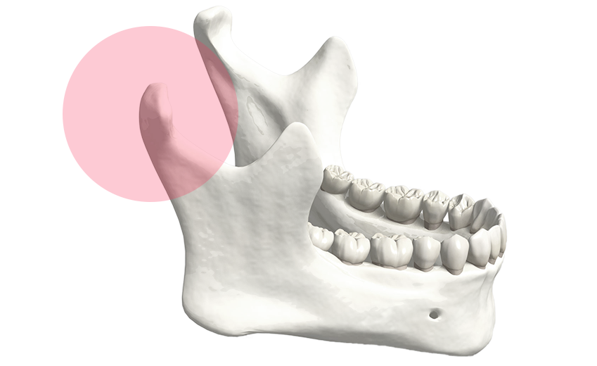 悪い歯並びによる影響・顎関節症のリスク増加